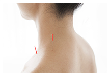 Studie: Alexander-Technik und Akupunktur lindern Nackenschmerzen
